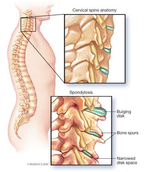 Cervical Spondylosis Causes