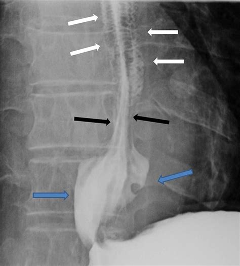 Human feline oesophagus | BMJ Case Reports