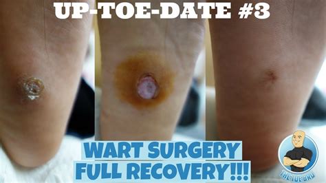 Before and After FULLY HEALED!!! Plantar Wart Removal Surgery for 7 year old boy!!! - YouTube