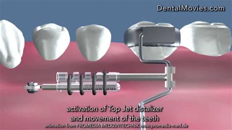 Distalization of the molar using Top Jet Distalizer - YouTube