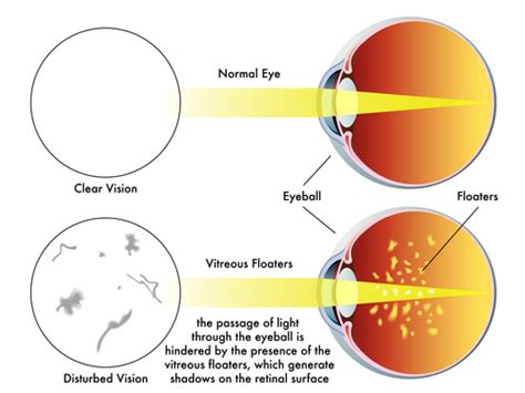 SEEING SPOTS? - Dr. John D. Bissell O.D.