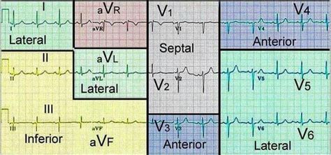 12 Lead Ekg Stemi Chart | SexiezPix Web Porn