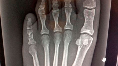 Fracture Toe - Fracture Treatment