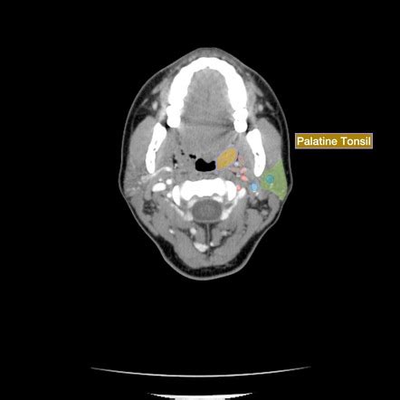 Normal Tonsils Vs Swollen Tonsils