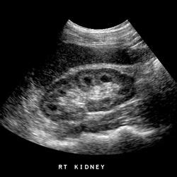 Renal Ultrasound | BlueGrass Renal Care | Georgetown