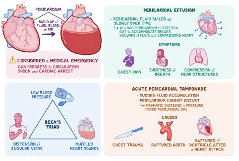 Pericardial Tamponade Ultrasound