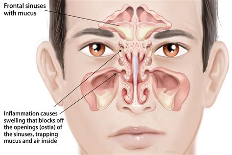 Acute and Chronic Sinusitis and Allergies