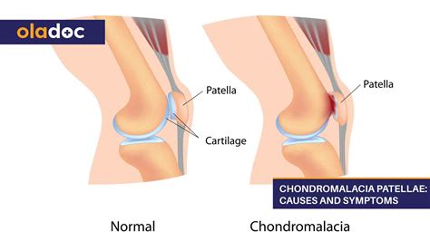 Chondromalacia Patellae: Causes and Symptoms | Bones and Joints | oladoc.com