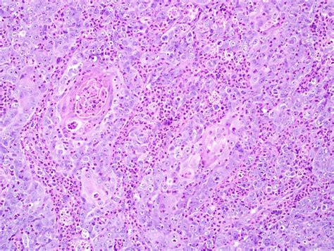 Nasopharyngeal Carcinoma Histology