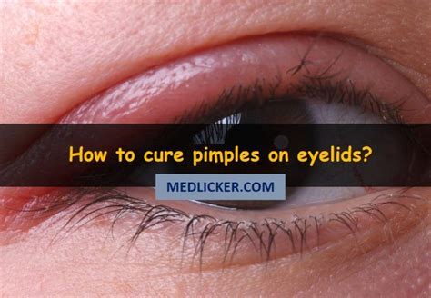 PIMPLES ON EYELIDS: causes, symptoms, treatment and prevention in 2021 | Pimple on eyelid, How ...