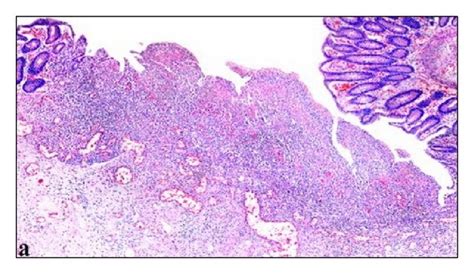 This image shows mucosal ulcer area (a) with the cells containing viral ...