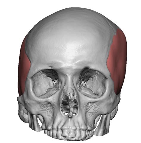 Plastic Surgery Case Study - Correction of Right Lopsided Head Shape Deformity with a Custom ...