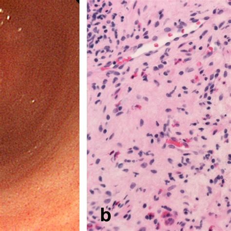 a: Upper gastrointestinal endoscopic findings of the pyloric zone of ...