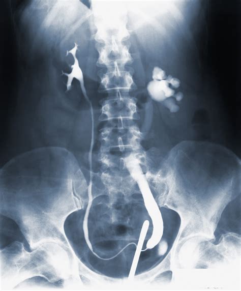 Pelvis X Ray: Purpose, Preparation & Procedure