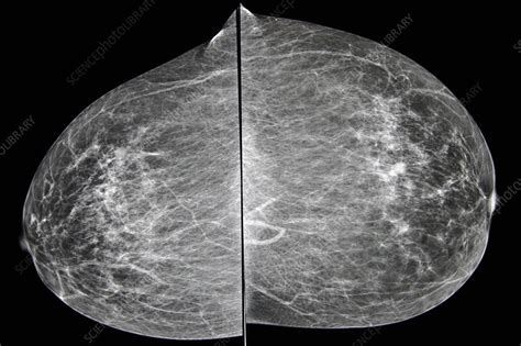 breast tumor, x-ray - Stock Image - C015/2217 - Science Photo Library