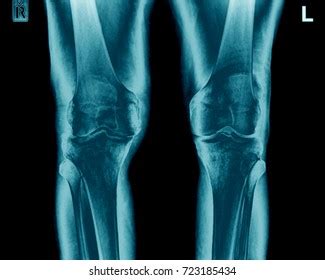 Xray Knee Showing Closed Fracture Displacement Stock Photo (Edit Now ...