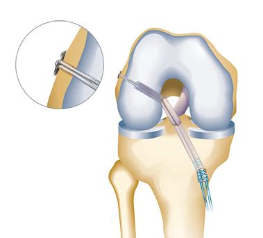 ACL reconstruction — Gormack Orthopaedics