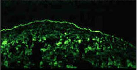 Ocular Cicatricial Pemphigoid: atypical presentation. EyeRounds.org - The University of Iowa