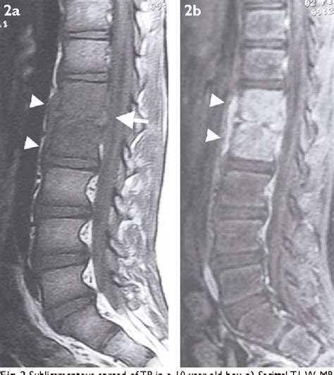 Figure 2 from Imaging of tuberculosis of the spine. | Semantic Scholar