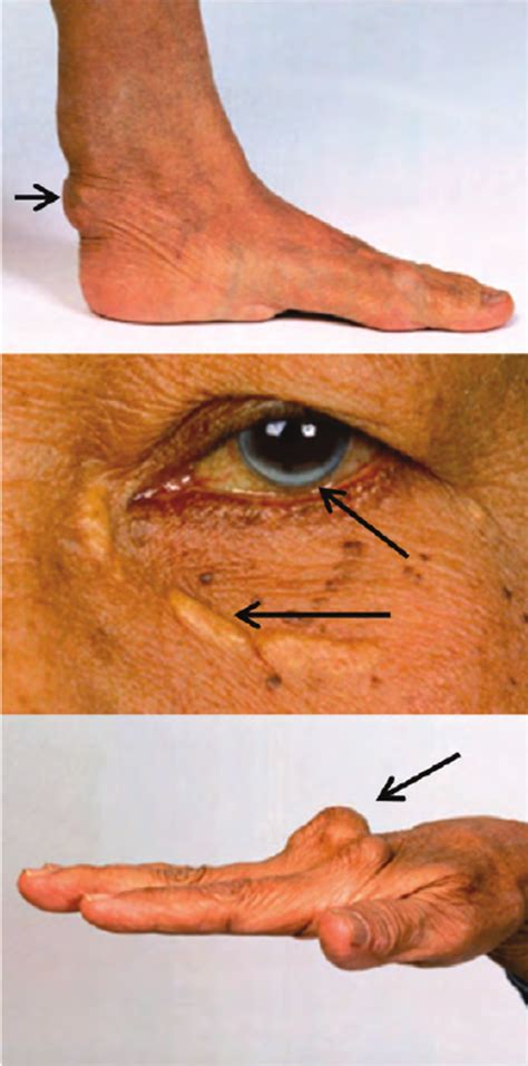 Xanthelasma Vs Xanthoma