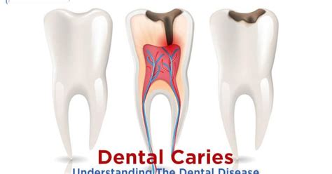 Dental Caries: Causes, Symptoms, Types & Treatment