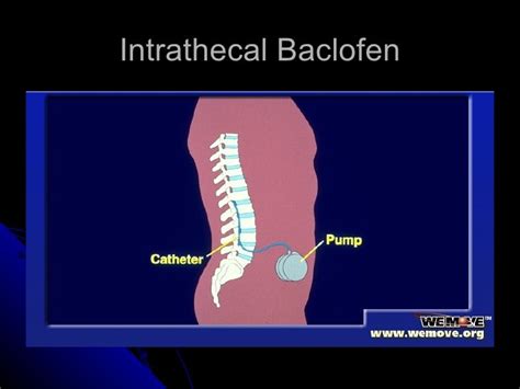 NurseReview.Org - Spasticity After Stroke