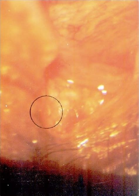 Mucopurulent conjunctivitis in the eye with larvae in situ