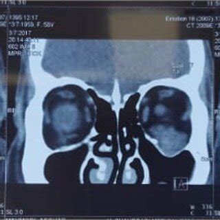 CT showed infraorbital canal enlargement due to homogenous,... | Download Scientific Diagram