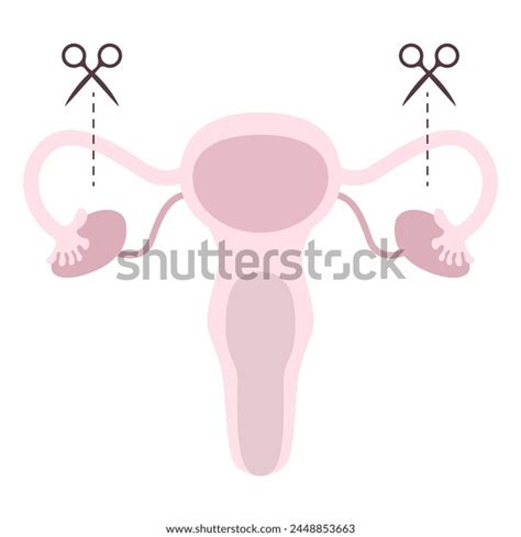 Tubectomy Reversal Tubal Ligation Surgical Procedure Stock Vector (Royalty Free) 2448853663 ...