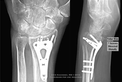 Distal Radius Fractures Involving The Volar Rim — OrthopaedicPrinciples.com