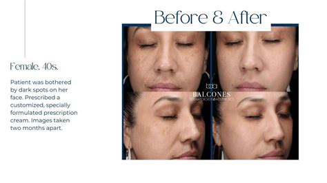 Pigmentation Treatment Before & After Gallery - Austin, TX: Balcones Dermatology & Aesthetics