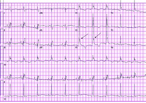 Osborn waves on admission ECG can be seen clearly in the precordial ...