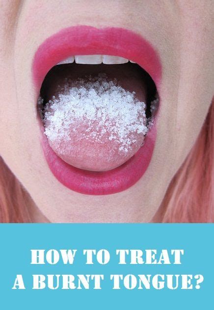 7 Best sore tongue ideas | tongue sores, canker sore, canker sore on tongue