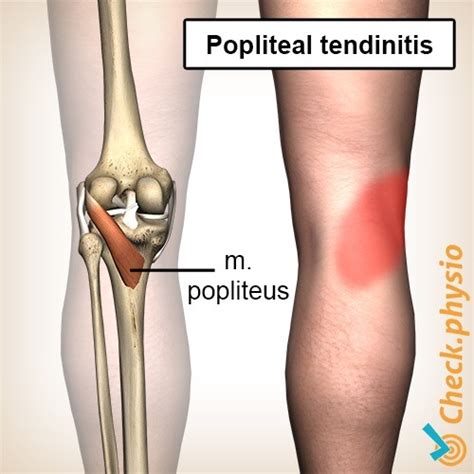 Popliteus tendinitis | Physio Check