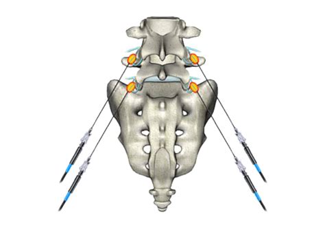 Radiofrequency Ablation Demystified | #1 Spine & Orthopedic Center