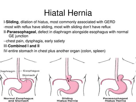 Esophagus Hiatal Hernia Surgery