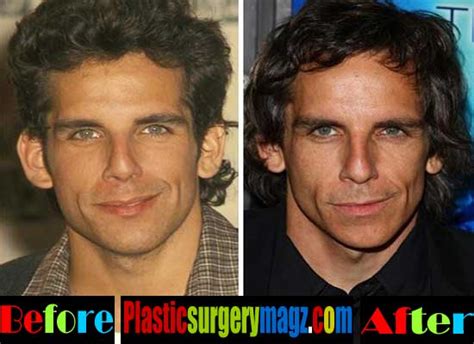 Ben Stiller Plastic Surgery Before and After | Plastic Surgery Magazine