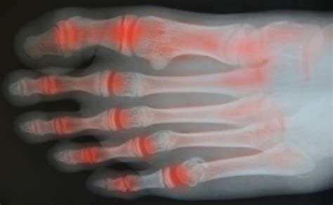 Symptoms of Psoriatic Arthritis in the Feet