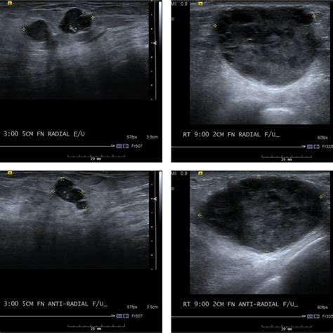 Bilateral diagnostic mammogram at the time of initial evaluation. Top... | Download Scientific ...