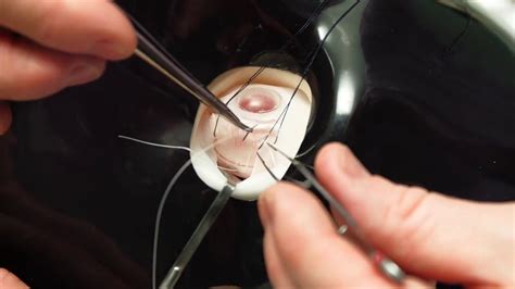 Simulated Surgery: Retinal Buckling: Placing the Sutures for a Scleral Buckle - YouTube