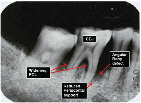 Annually Radiographic Periodontal Bone Loss Rates of Tooth Affected Severe Advanced ...