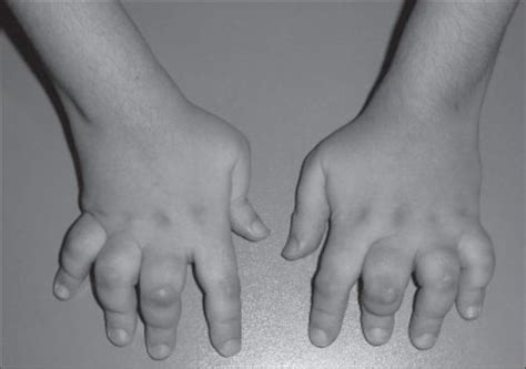 Juvenile Idiopathic Arthritis (JIA) Signs, Subtypes, Cause, Diagnosis & Treatment