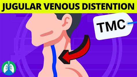 What are the Causes of Jugular Venous Distention (JVD)? | TMC Practice Question - YouTube