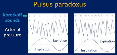 How to check for pulsus paradoxus? – All About Cardiovascular System ...