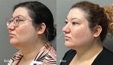 Chin Liposuction Before & After — HZ Plastic Surgery