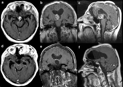 Preoperative gadolinium-enhanced MRI showing a 2.4 cm × 2.6 cm × 3.3 cm... | Download Scientific ...