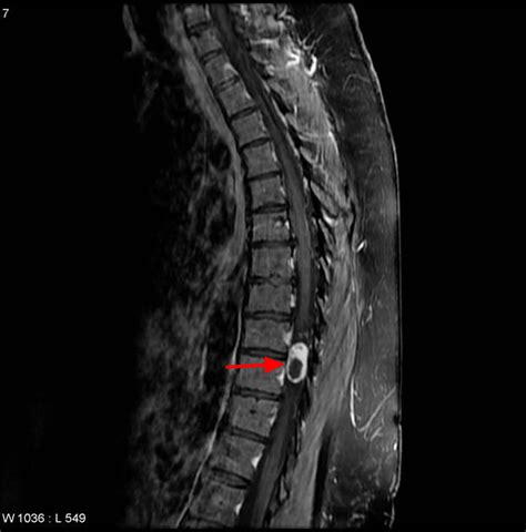 Schwannoma - Causes, Symptoms, Diagnosis. Treatment