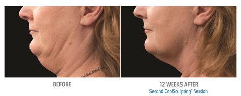 Get Rid of a Double Chin by Freezing Fat | Laser Aesthetic Center