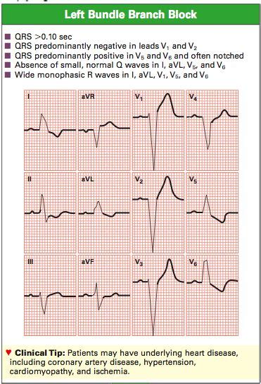 LBBB criteria | ECG teaching resources | Pinterest