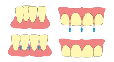 IPR | Dental interproximal reduction in orthodontics 🦷